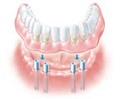 Unterkieferprothese auf vier Implantaten